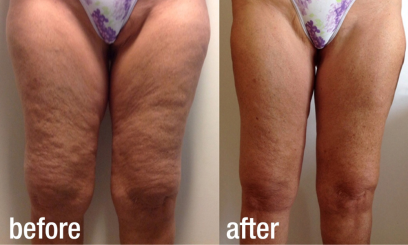 Фотона Боди 3